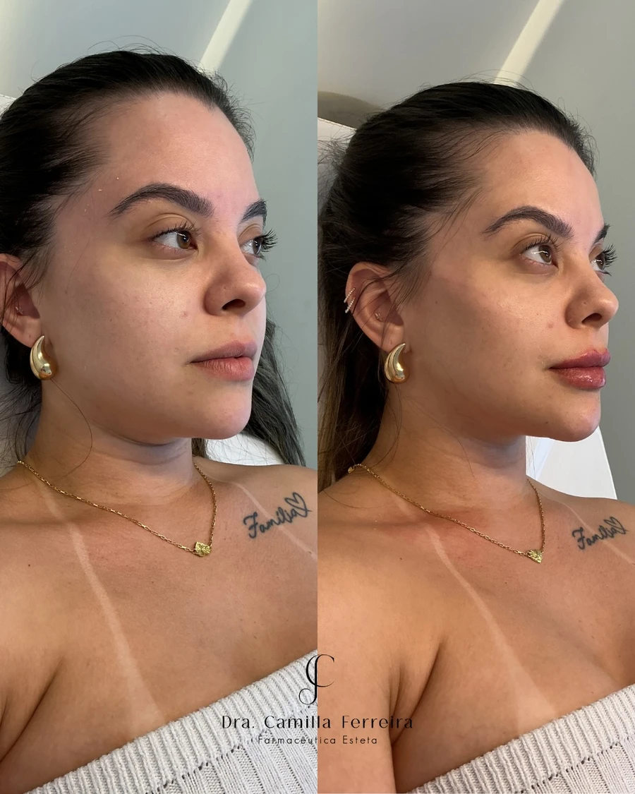 Montagem de antes e depois em ângulo de três quartos, registro 02